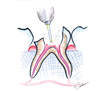 pulpotomy pulpectomy